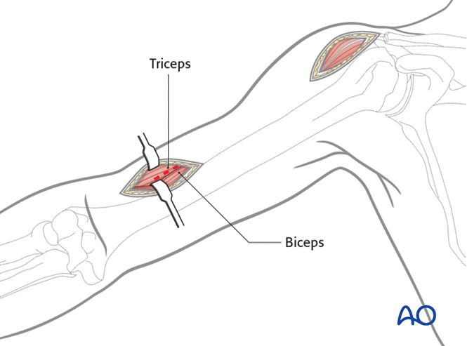 MIO transdeltoid lateral approach to the humerus