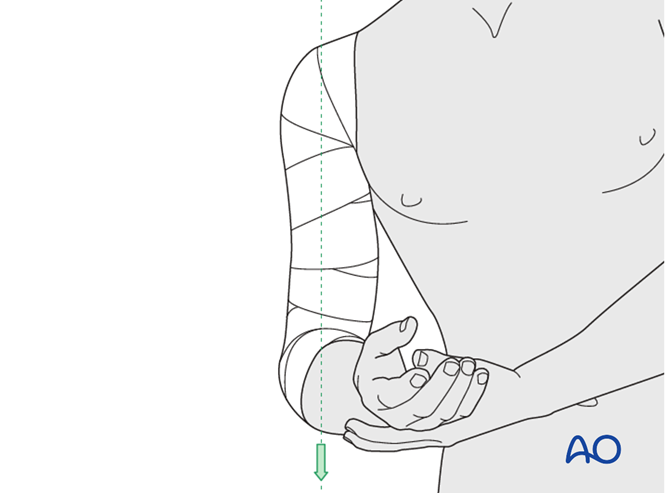 Nonoperative treatment for Wedge fracture, intact wedge