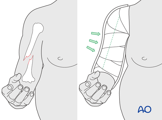 Tendency for varus malalignment, particularly in obese patients