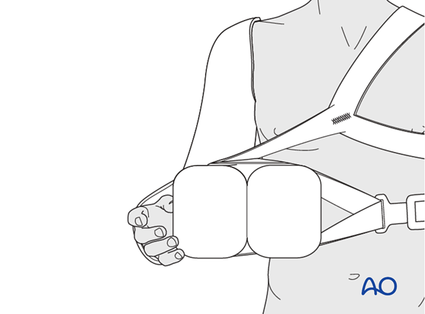 Fix the arm in neutral position (ie 15° external rotation of the flexed forearm using a shoulder abduction pillow).