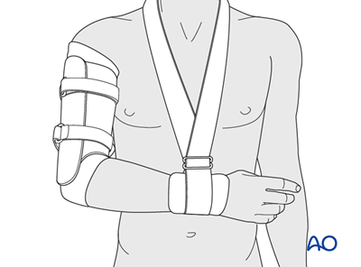 nonoperative-treatment-for-simple-fracture-transverse