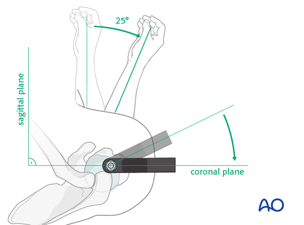 Rotational implant position
