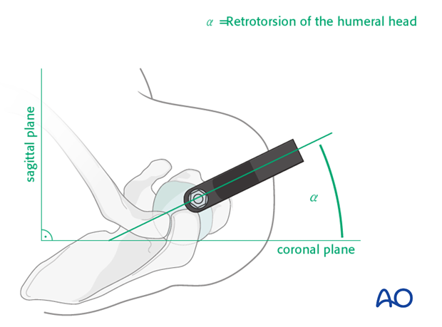 Rotational implant position