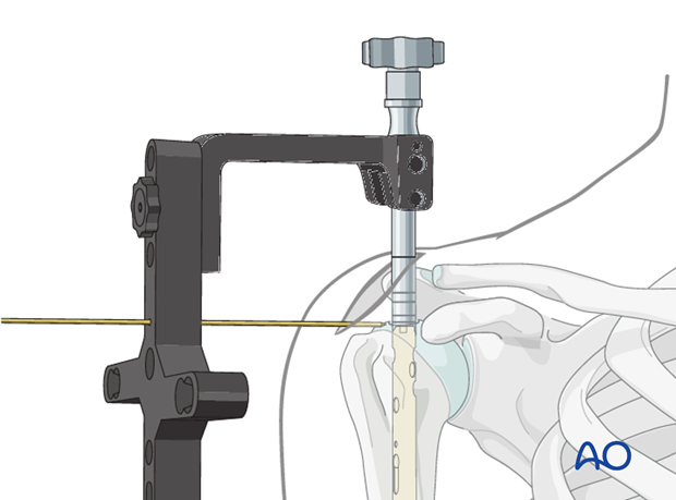 A K-wire placed through an aiming device may help to adjust the appropriate insertion depth.