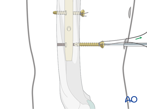 Pearl: absorbable suture around the screw