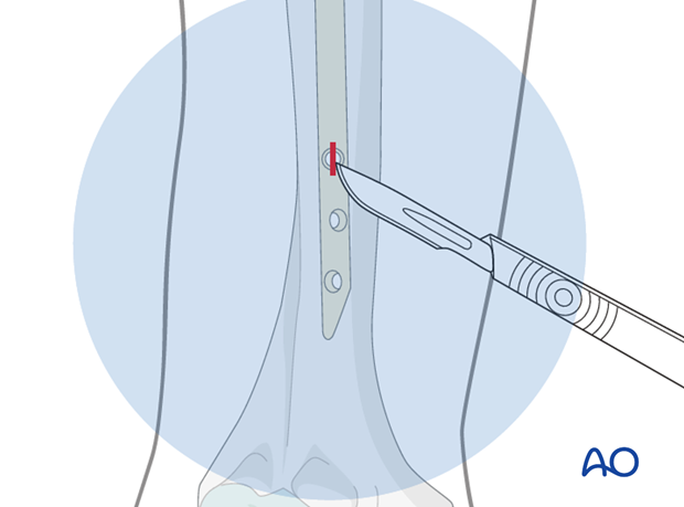 Antegrade nailing with bent nail - Skin incision for distal interlocking