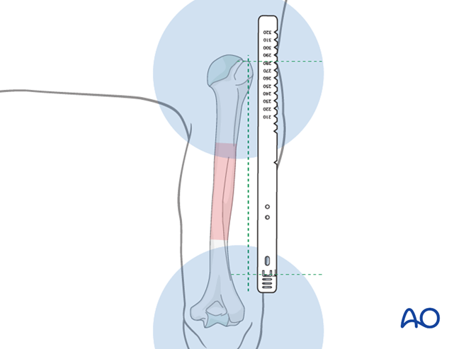 Retrograde nailing for Simple fracture, spiral
