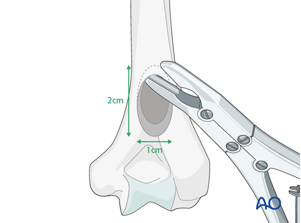 Create a central supracondylar entry portal.