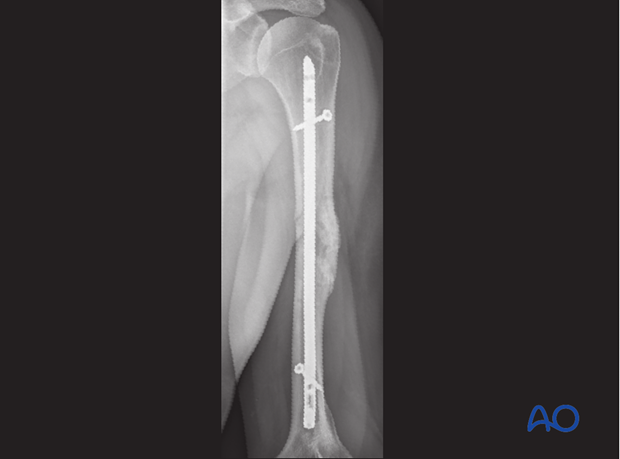 X-ray showing final construct