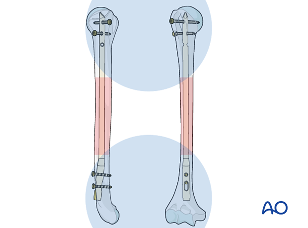 Surg'X – Clou intramédullaire verrouillé - Novetech Surgery