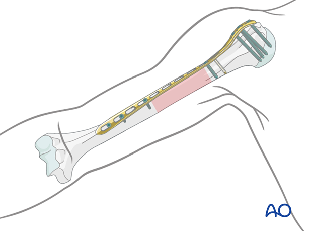 If the fracture morphology requires a longer plate, covering most of the length of the humerus, it is twisted to form a helix.