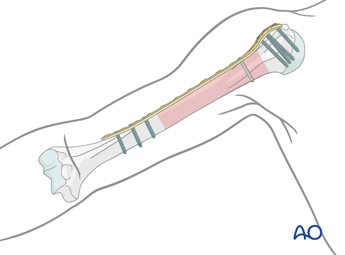 MIO - Bridge Plating For Simple Fracture, Spiral