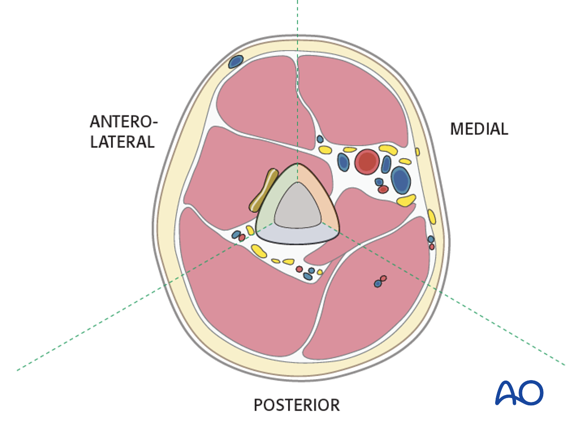 MIO - Bridge Plating For Simple Fracture, Spiral