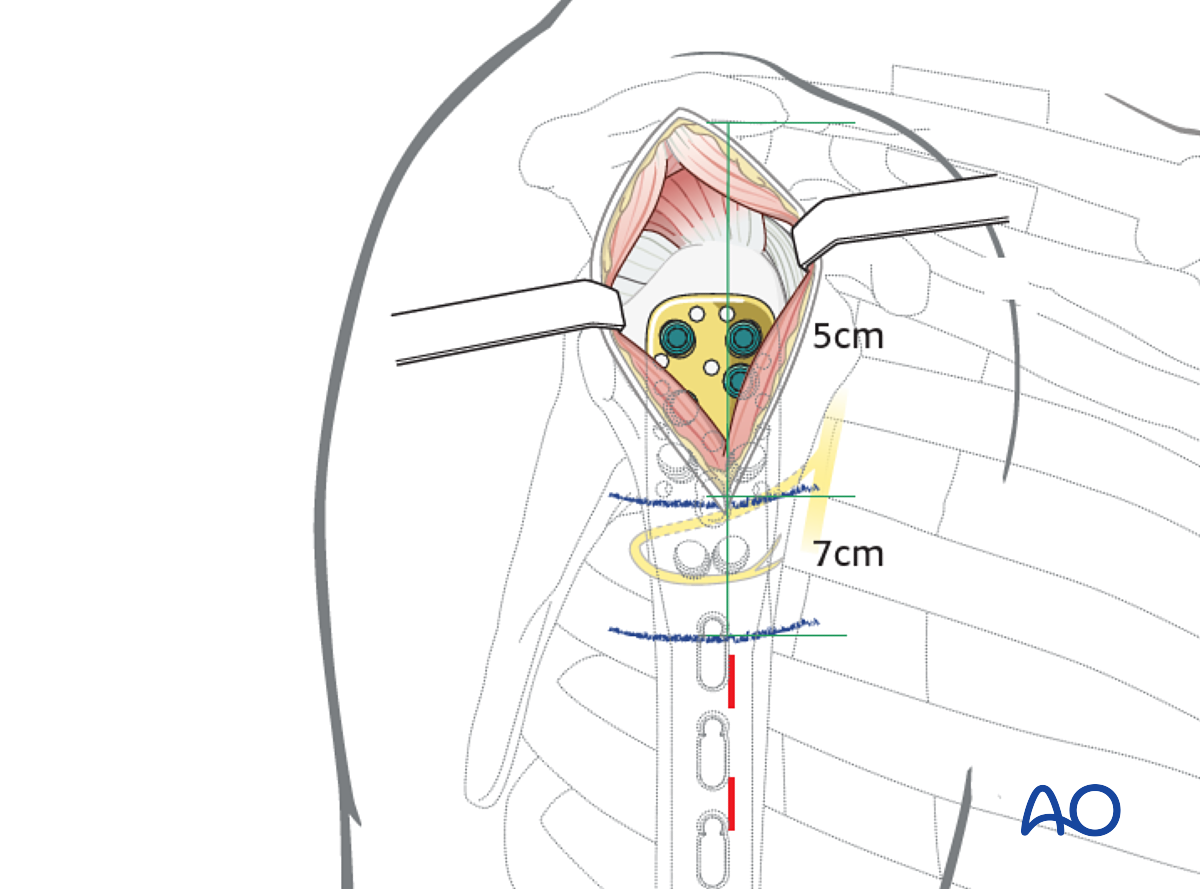 MIO - Bridge Plating For Simple Fracture, Spiral