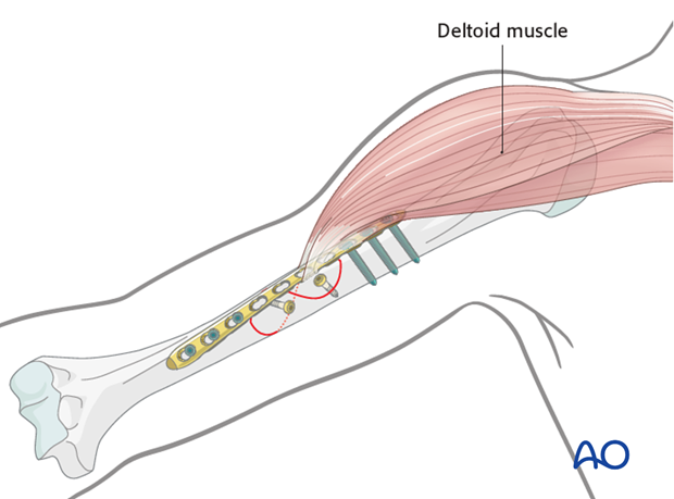 The plate may need to be contoured and/or twisted to form a helix.