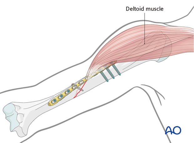 The plate may need to be contoured and/or twisted to form a helix.