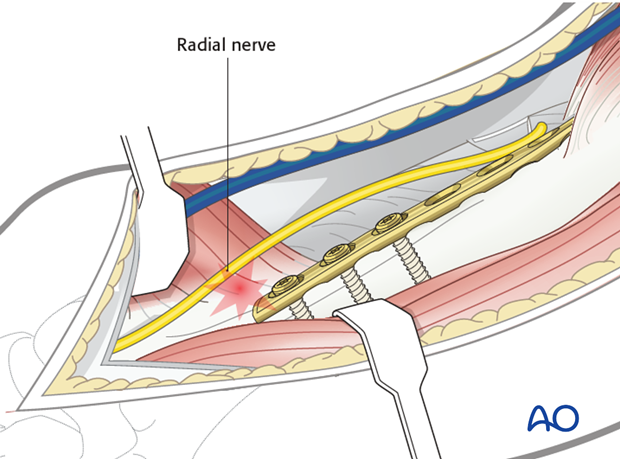 The radial nerve is at risk if the plate is applied to the lateral surface in the distal third.