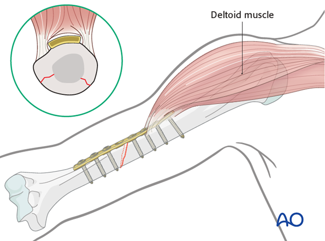 ORIF - Compression plating for Simple fracture, oblique