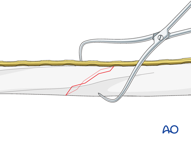 Reduction forceps can interfere with plate application for simple oblique fractures.
