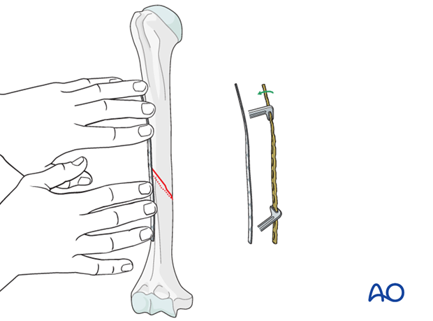 Fitting the plate to the bone