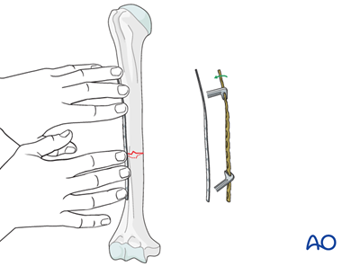 ORIF - Compression plating for Simple fracture, transverse