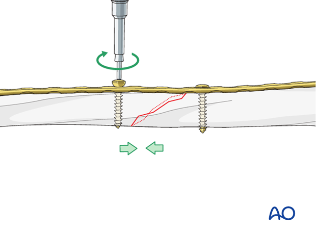 Tightening of screws for fracture compression