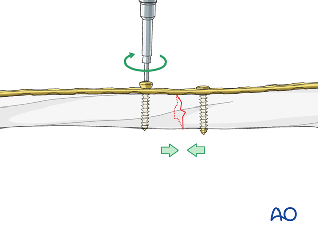 Tightening of screws for fracture compression