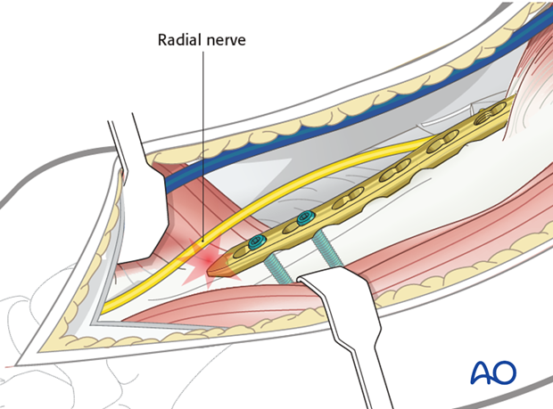 The radial nerve is at risk if the plate is applied to the lateral surface in the distal third.