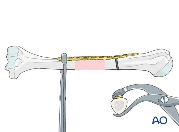 Alignment and fixation of the distal fragment