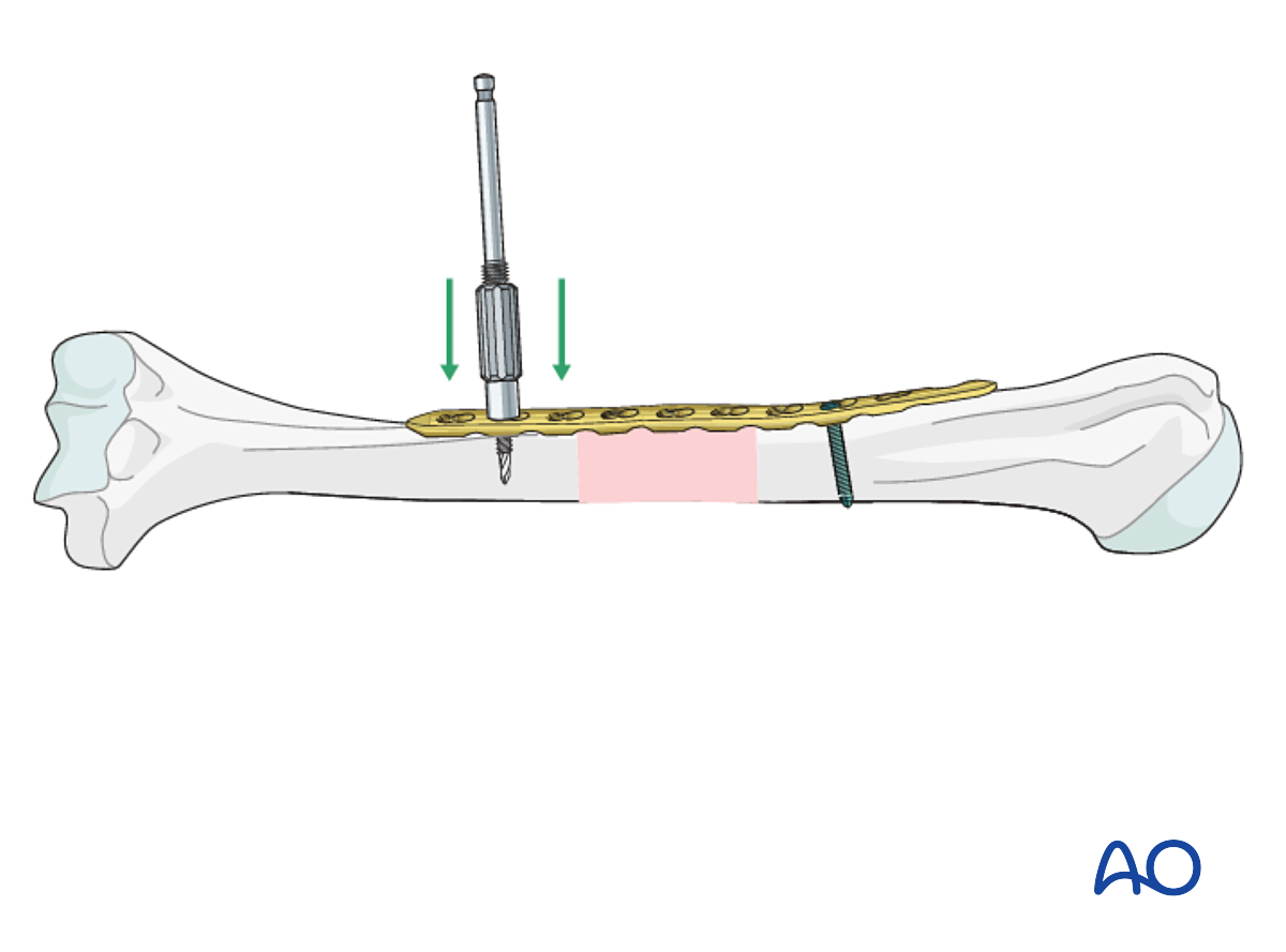 ORIF Bridge Plating middle 1 3 For Multifragmentary Fracture ORIF Bridge Plating middle 1 3 For Multifragmentary Fracture