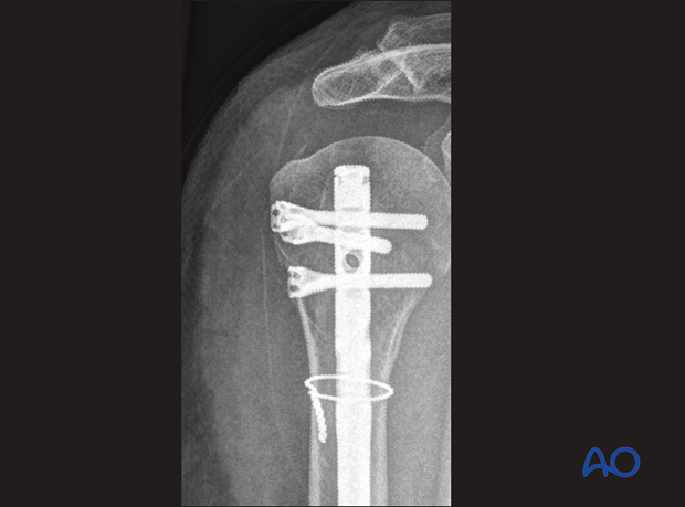 Take particular notice of the position of the proximal end of the nail, the location and length of all interlocking screws.