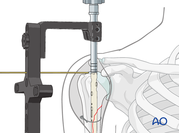 A K-wire placed through an aiming device may help to adjust the appropriate insertion depth.