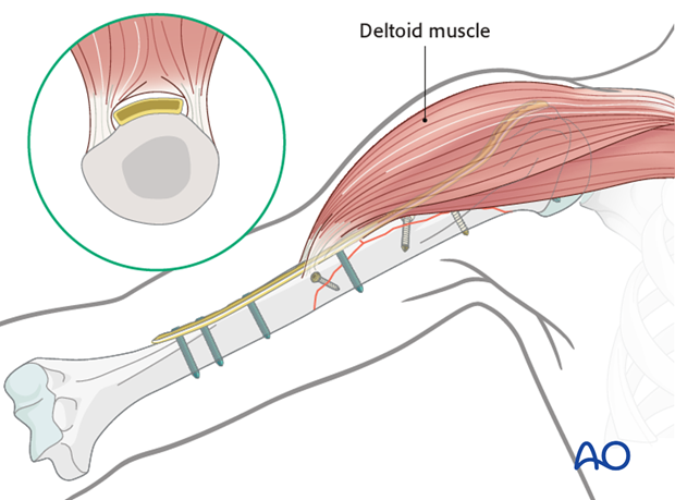 Plating of proximal 1/3 fractures