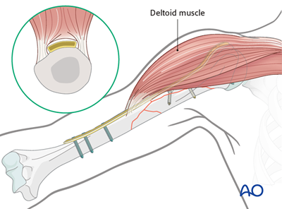 ORIF - Plate fixation (proximal 1/3) for Wedge fracture, fragmentary wedge