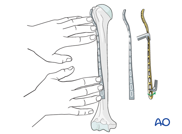 Plating of proximal 1/3 fractures