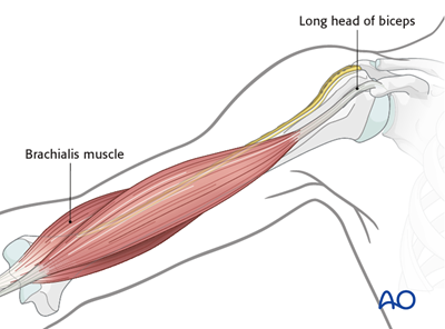 ORIF - Plate fixation (proximal 1/3) for Wedge fracture, intact wedge