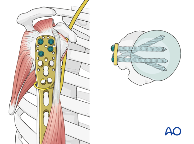 Plate fixation to humeral head
