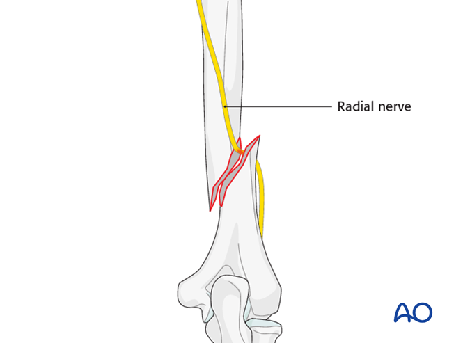 ORIF - Plate fixation (distal 1/3) for Multifragmentary fracture ...