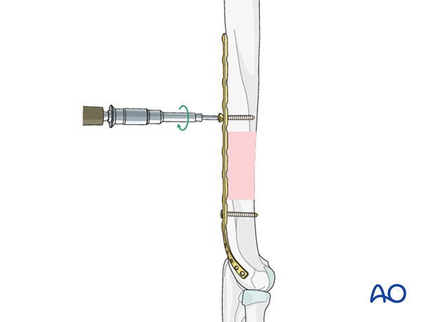 Insert first proximal screw