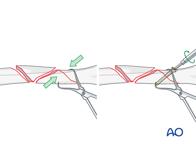 ORIF - Plate fixation (proximal 1/3) for Multifragmentary fracture ...