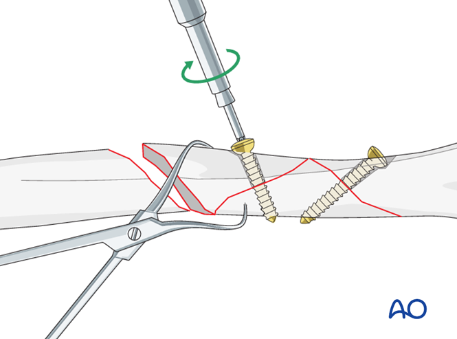 ORIF - Plate fixation (proximal 1/3) for Multifragmentary fracture ...