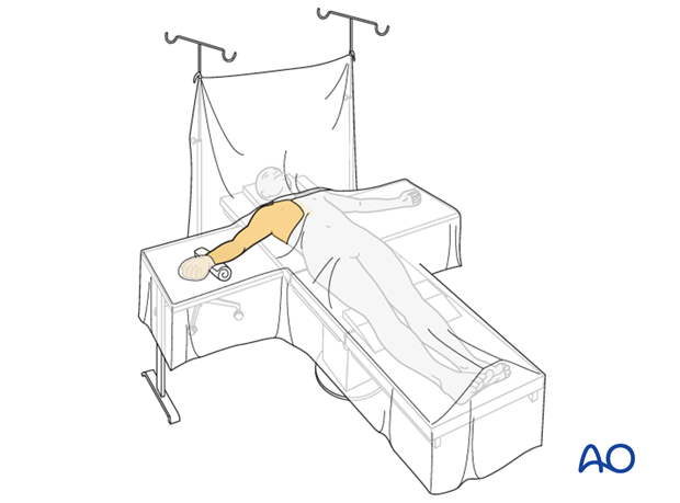 Supine patient positioning and portal designation. (A) Supine position