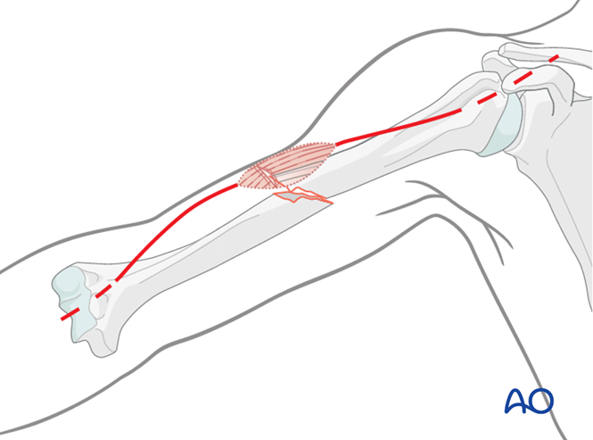 open-fractures-in-the-humeral-shaft