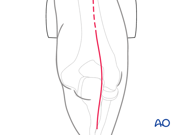 Skin incision of triceps-split or triceps-on approach