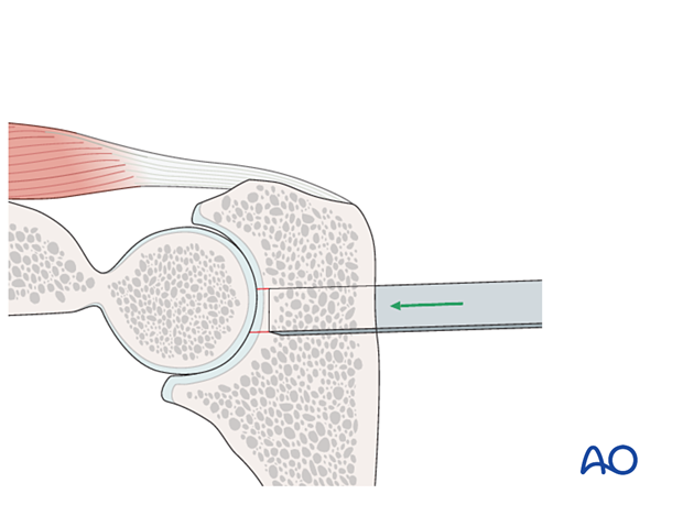 Use of an osteotome to complete the osteotomy