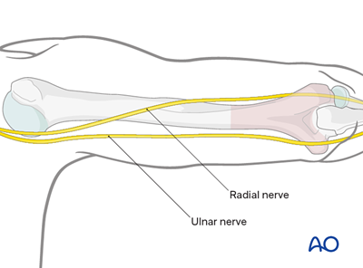 Posterior paratricipital approach (Alonso-Llames) to the distal humerus