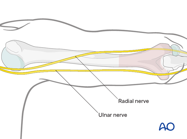 The distal humerus and distal humeral shaft can be exposed with the posterior paratricipital approach.