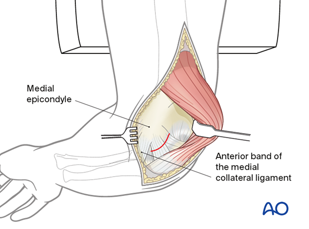 To maximize the exposure distally at the level of the joint, incise the posterior band of the medial collateral ligament on the medial aspect of the ulnohumeral joint.