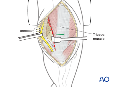 Posterior triceps-elevating approach (after Bryan and Morrey) to the ...