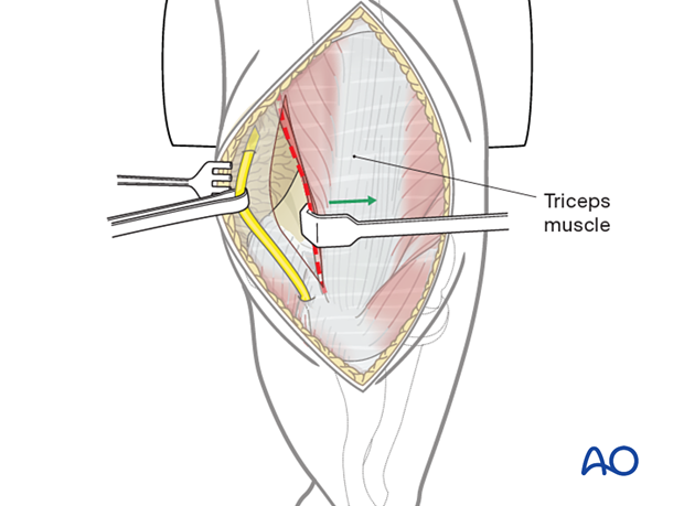 Detachment of the triceps insertion subperiosteally from the proximal ulna towards the radial side